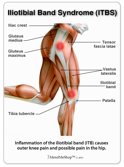 Iliotibial Band Syndrome:What is it? How to treat it. - Osteopath West