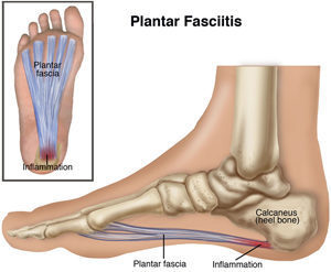 Treating Plantar Fasciitis - With a High Load Strength Training